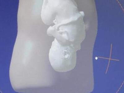 Τρισδιάστατη εκτύπωση αγέννητου μωρού (σ...