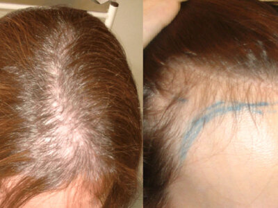 Γυναίκα με ανδρογενετική αλωπεκία