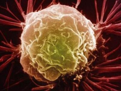 Πειραματική θεραπεία φρενάρει την μετάστ...