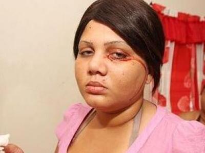 Η 19χρονη που  πάσχει από τη σπάνια διατ...