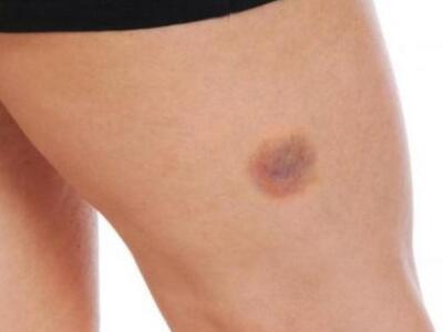 Βγάζετε ανεξήγητες μελανιές; ΔΕΙΤΕ τί μπ...