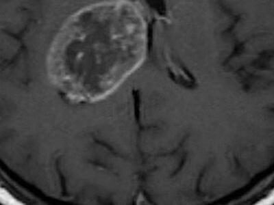 Νέα τεχνική καταπολέμησης του καρκίνου μ...