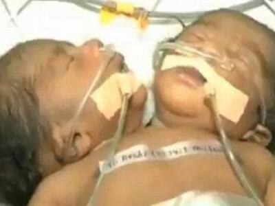 Ινδία: Μωρό γεννήθηκε με δύο κεφάλια