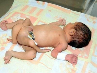 Μωρό με έξι πόδια γεννήθηκε στο Πακιστάν!
