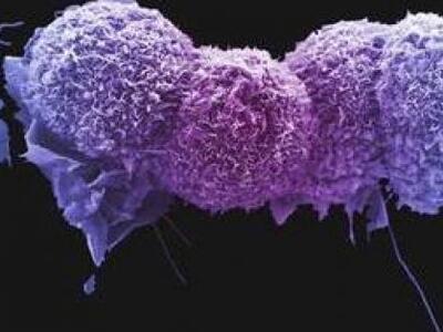 Κατά 75% θα αυξηθεί ο καρκίνος μέχρι το 2030