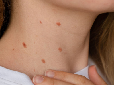 Εμβόλιο κατά του καρκίνου του δέρματος: ...