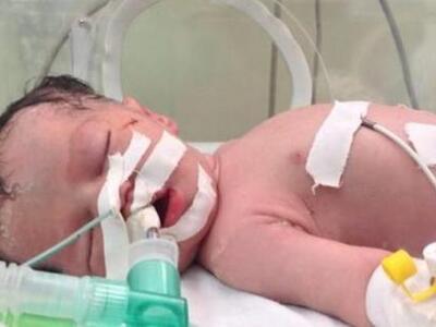 Γάζα: Πέθανε το μωρό-θαύμα που είχε γενν...