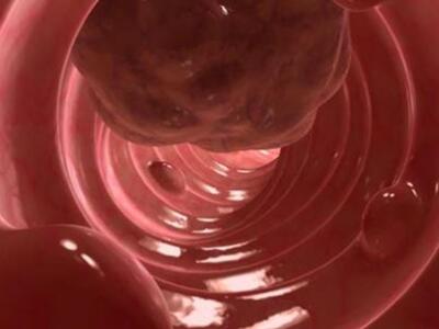 Αύξηση κρουσμάτων καρκίνου παχέος εντέρο...