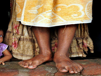 25 Απριλίου: Παγκόσμια Ημέρα κατά της Ελονοσίας