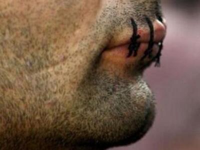 Μετανάστης έραψε το στόμα του!