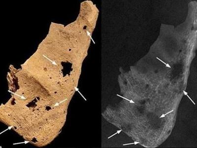 Μεταστατικός καρκίνος βρέθηκε «απολιθωμέ...