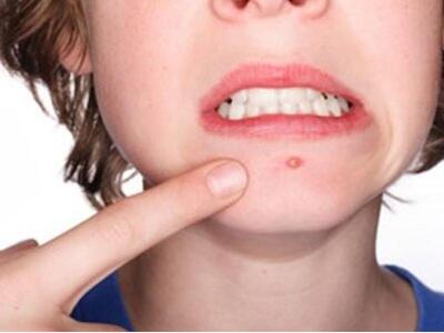 Πως εξαφανίζεις τα σπυράκια της τελευταί...