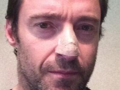 ΗΠΑ: Φόβους για καρκίνο του δέρματος εξέ...