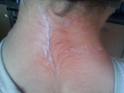 Πάτρα: Μαθητές δημοτικού σχολείου με αλλ...