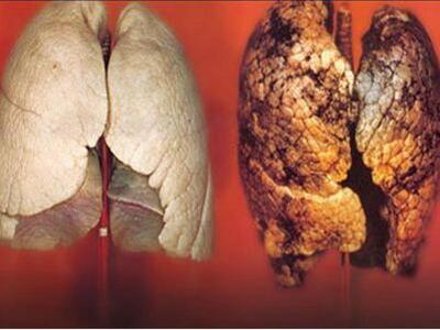 Ένας στους τρεις καρκίνους μπορεί να αποφευχθεί