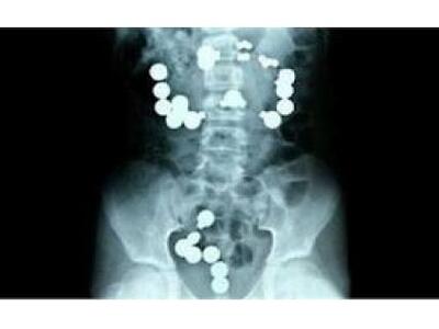 Βρέφος κατάπιε 42 μαγνητάκια ψυγείου!