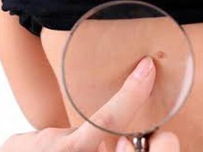 Τι είναι η ελιά (σπίλος) που περιβάλλετα...