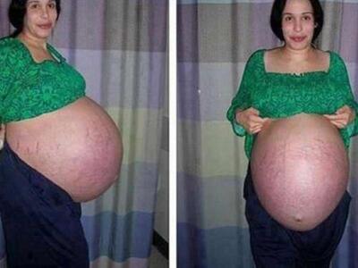 Γυναίκα στην Ινδία γέννησε 11 παιδιά!!!
