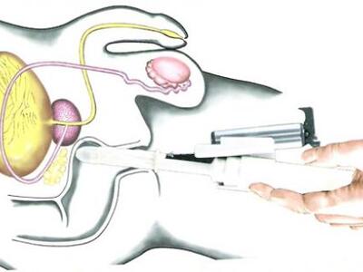Ηλεκτρονική «μύτη» εντοπίζει τον καρκίνο...