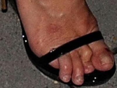 Τραγικό! Τα απαίσια νύχια διάσημου μοντέ...