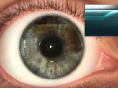 Δείτε την επαναστατική Wavelight Refract...