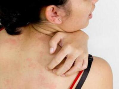 Αλλεργίες στο δέρμα: Μάθετε πώς θα αντιμ...