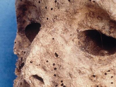 Η ανάλυση του DNA της μεσαιωνικής μούμια...