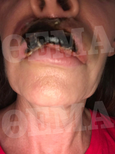 Η Κατερίνα Πλουμιδάκη μετά την πλαστική ...