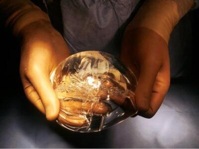 Έχασε τα επιθέματα της σιλικόνης την ώρα...