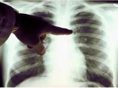 Ο καρκίνος του πνεύμονα μπορεί να παραμε...