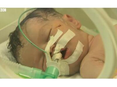 Γάζα: Γιατροί έσωσαν βρέφος με καισαρική...