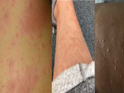 Κορωνοϊός: Τα εξανθήματα που προκαλεί η ...