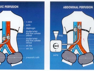 Η χρόνια κόπωση ευθύνεται για τον καρκίν...