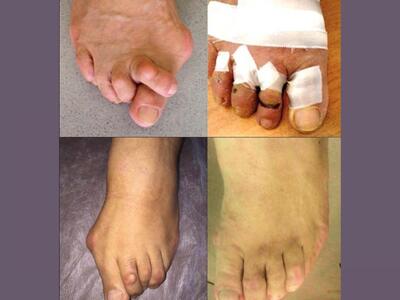 Αντιμετωπίστε τις παραμορφώσεις του άκρο...