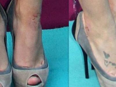 Το άγχος... της έχει προκαλέσει ψωρίαση!