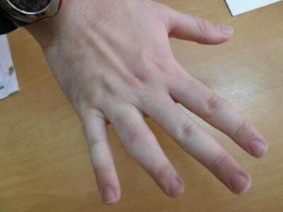 Στοπ στις αναπηρίες των δακτύλων των χερ...