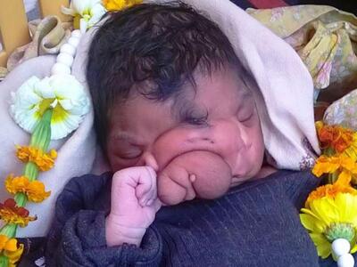 Ινδία: Μωρό γεννήθηκε με προβοσκίδα και ...