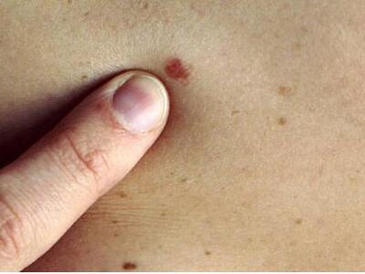 15-20 ετών, οι κρίσιμες ηλικίες για το μελάνωμα