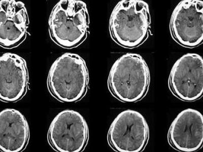 Νέα επιστημονική μέθοδος κατά της σκλήρυ...