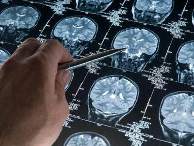 Σε μια πενταετία προληπτική θεραπεία για...