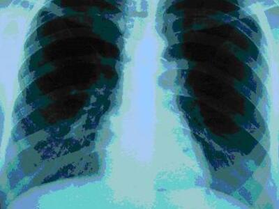 Ιατρική ημερίδα για τον καρκίνο του πνεύ...