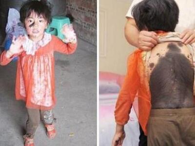 Σπάνια ασθένεια γεμίζει με τρίχωμα το σώ...