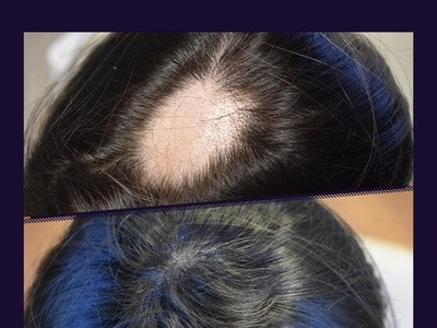 Εντυπωσιακό αποτέλεσμα μετά από Θεραπεία...