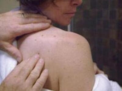 Δυτική Ελλάδα: Δωρεάν εξετάσεις για μελά...