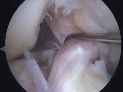 Επέμβαση ρήξης χιαστού για πρώτη φορά στον Πύργο