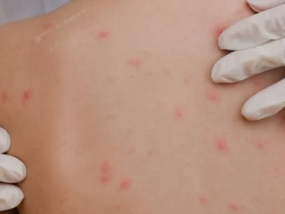 Αύξηση κρουσμάτων ιλαράς και ερυθράς στη...