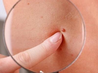 Περισσότερες από 11 ελιές στο μπράτσο δε...