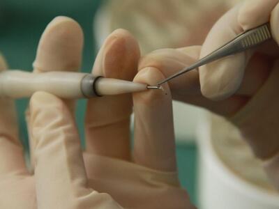 Μεταμόσχευση μαλλιών, απλή & ανώδυνη...