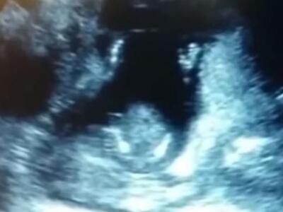 Έμβρυο χτυπά παλαμάκια στον ρυθμό νανουρ...