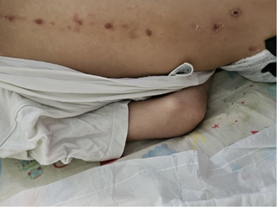 Πάτρα: Μυστήριο με τα σημάδια στο 10χρον...